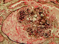 Crescentic glomerulonephritis