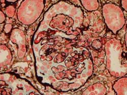 Crescentic glomerulonephritis